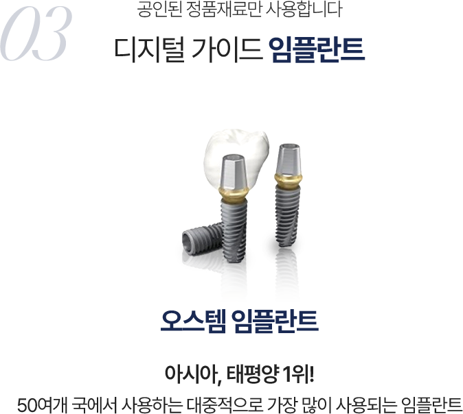 디지털 가이드 임플란트