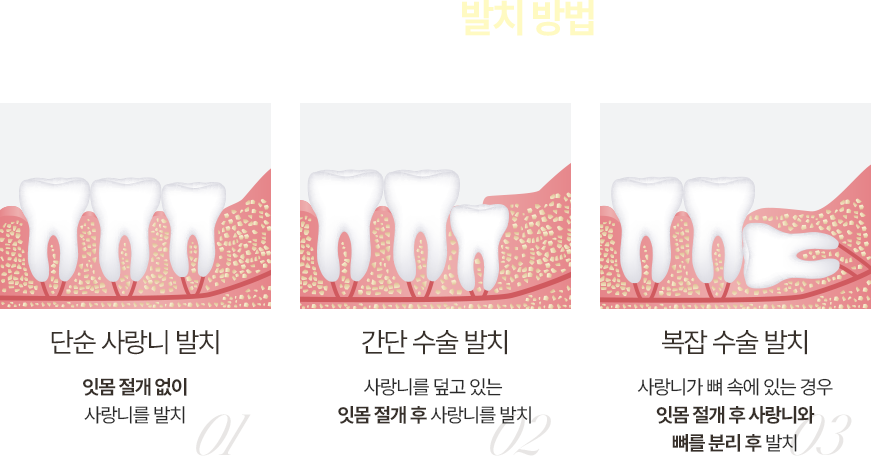 사랑니 발치 방법
