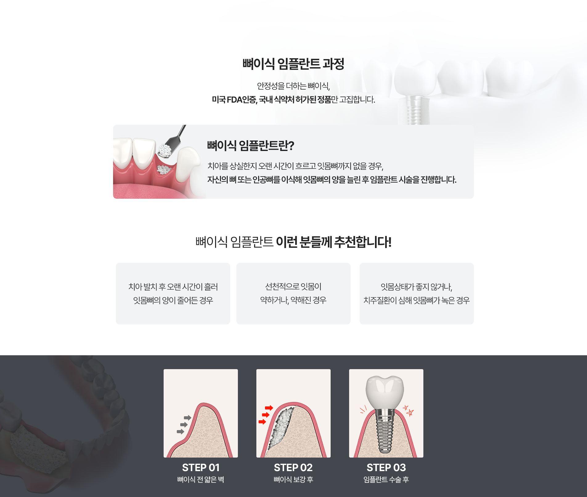 뼈이식 임플란트 과정