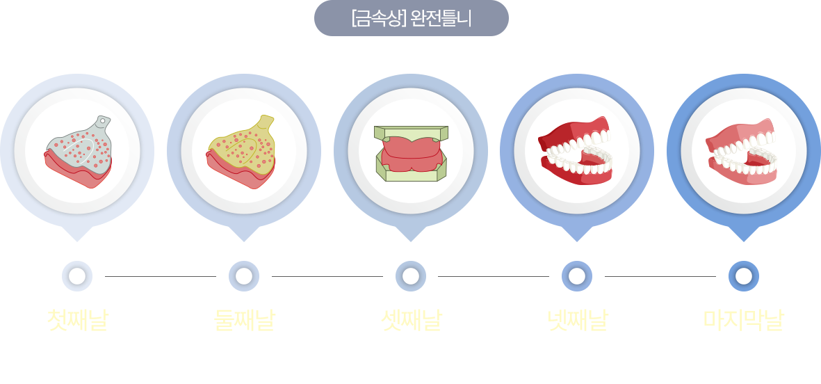 금속상 완전틀니