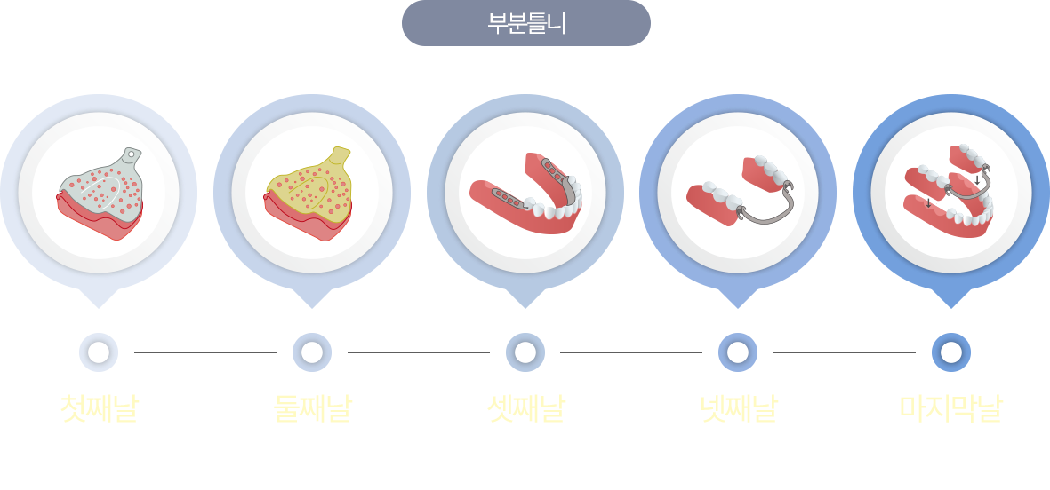 부분틀니