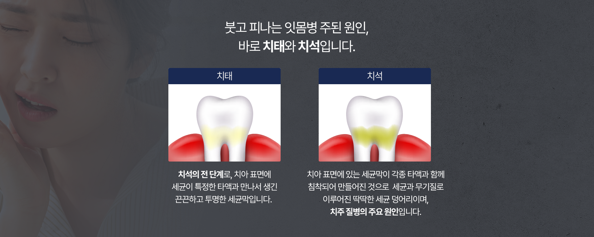 붓고 피나는 잇몸병 주된 원인,