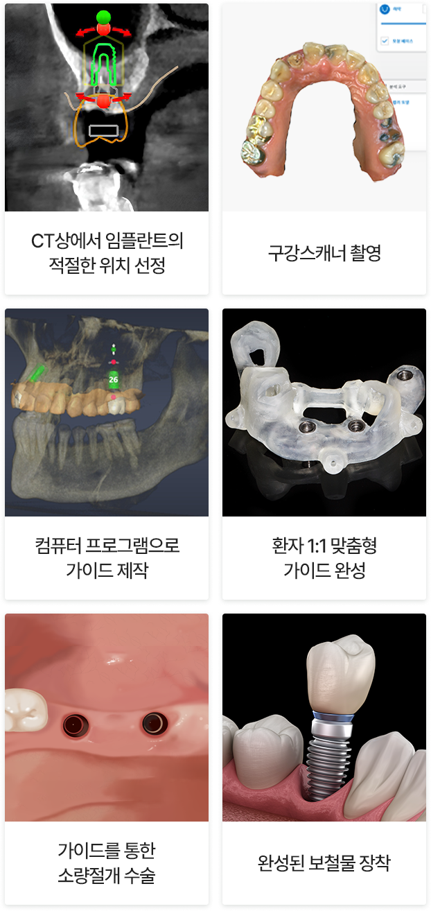 디지털 임플란트