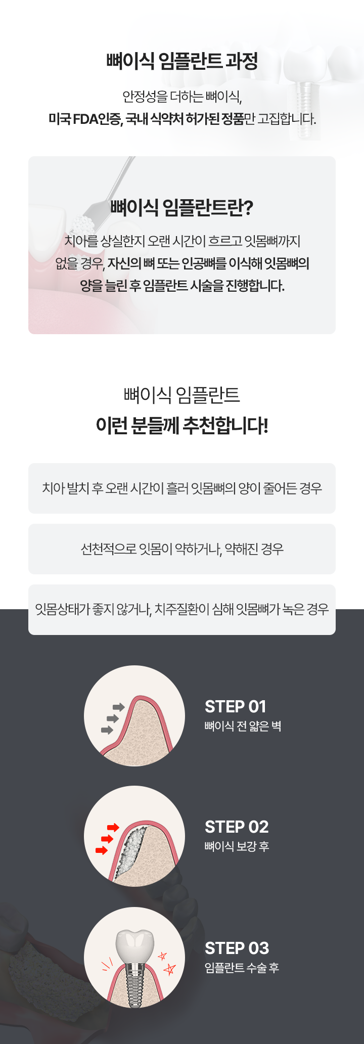 뼈이식 임플란트 과정