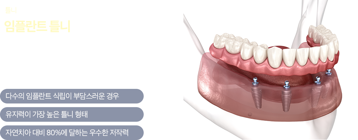 임플란트 틀니