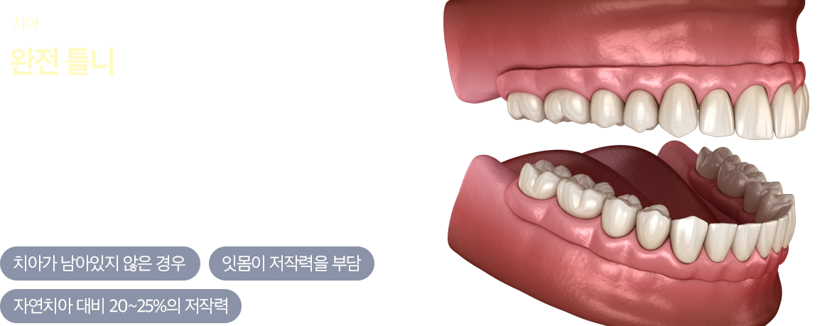 완전틀니